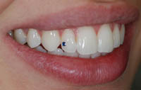 biancamento dentale